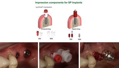 The benefits of tissue level implants restoratively - ITI Blog