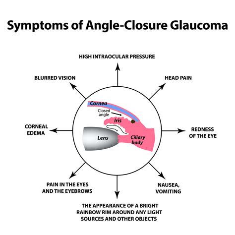 Subacute Angle Closure Glaucoma | Eye Patient