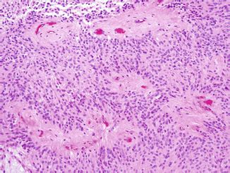 Ependymoma | Oncohema Key