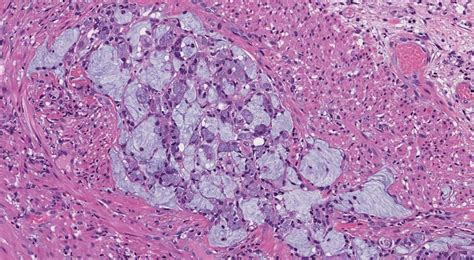 Goblet cell adenocarcinoma of... - Ottawa Atlas of Pathology