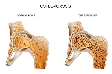 Healthy Bones: Nutrients needed beyond calcium and vitamin D