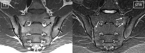 Defining active sacroiliitis on MRI for classification of axial ...