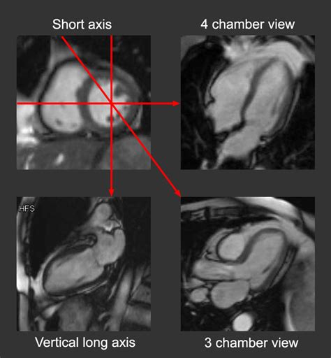 Cardiac MRI