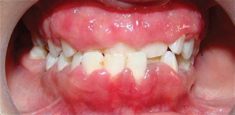 Here's How To Treat Swollen Gums - Med Scoop Daily