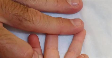 Crooked fingers: possible causes of deformation, correction options, photo | Diseases and ...