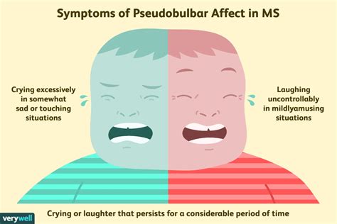 Pseudobulbar Affect in MS: Symptoms, Diagnosis, and Treatment