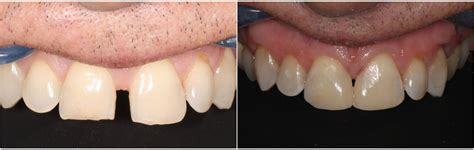 Diastema, Bioclear Matrix, Diastema Closure London