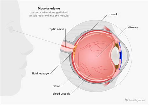 Macular Edema: Causes, Symptoms, Diagnosis, and Treatments