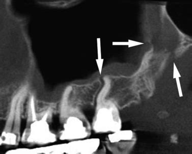 Maxillary Tuberosity Fracture