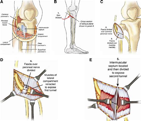 Paley’s technique 11 of 2-tunnel peroneal nerve decompression is shown.... | Download Scientific ...