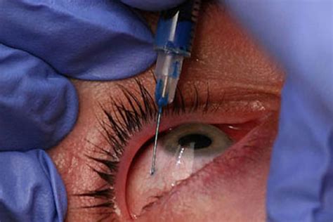 Latest eye injection proposals draw sharp rebuke from ophthalmology - Insight