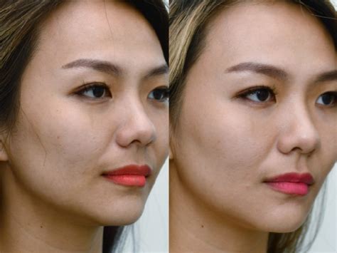 PicoSure Laser Review: So Good For Treating Scars! | ngjuann.com