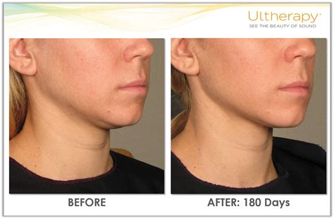 Ultherapy results under the chin. #Ultherapy #UnderChinLift #BeforeandAfter Lower Face Lift ...