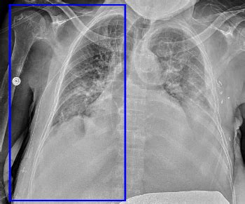 LinesTubes.com - Lines, Tubes, and Devices in the Upper Mediastinum