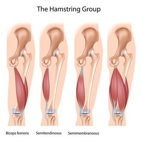 Hamstring tendon tear | Dr Geier