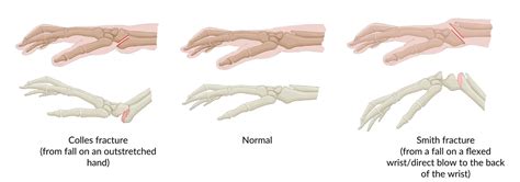 Reverse Colles Fracture