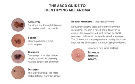 Melanoma Skin Cancer Diagram