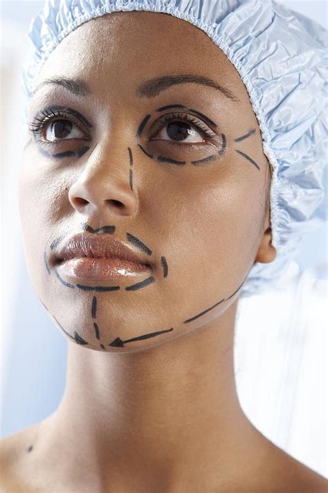 Facelift Surgery Markings Photograph by Adam Gault - Fine Art America