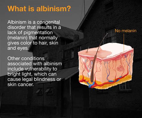 What is albinism and what causes it? | Infographic News | Al Jazeera