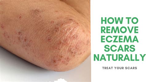 How To Remove Eczema Scars Naturally - Treat Your Scars