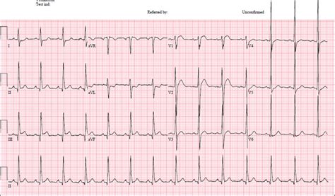 12 Lead Ecg With St Elevation