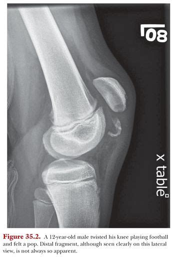 Patella Sleeve Fractures | Obgyn Key