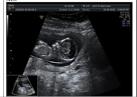 Hydranencephaly Ultrasound