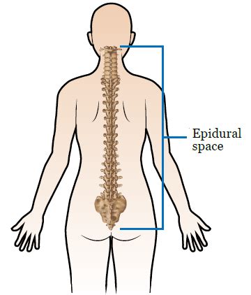 Epidural Steroid Injection | Memorial Sloan Kettering Cancer Center