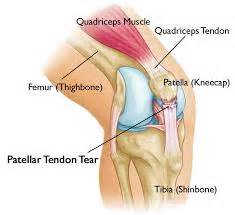 Patellar Tendon Rupture | Treatment, surgery and rehabilitation | SportsMD