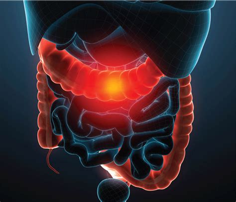 What’s new in treating ulcerative colitis and diverticulitis