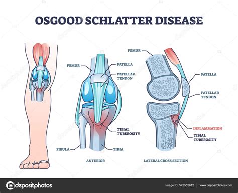 Osgood schlatter disease condition with knee joint pain outline diagram Stock Vector Image by ...