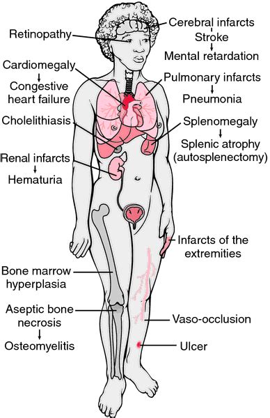 Describe the Symptoms of Sickle Cell Anemia - HarrykruwPerez