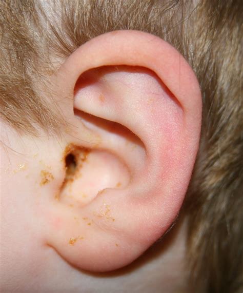 Signs of Ear Infection in Toddler - New Kids Center