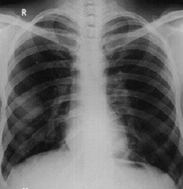 Chest X-ray showing clear lung fields. | Download Scientific Diagram