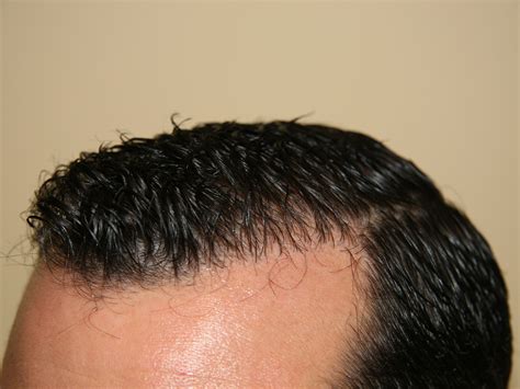 Case-7973 | Leonard Hair Transplant Associates