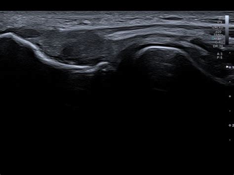 Partial tear common extensor tendon | Ultrasound Cases