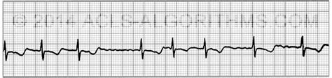 Atrial Fibrillation