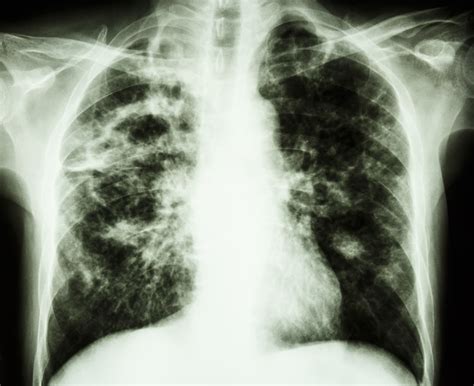 Tuberculosis - Net Health Book