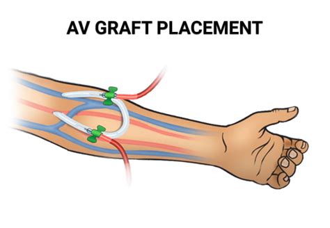 Fistula For Dialysis Placement