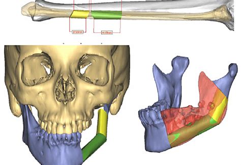 Comprehensive Reconstruction of Mandibular Defects with Free Fibula Flaps and Endosseous Implants