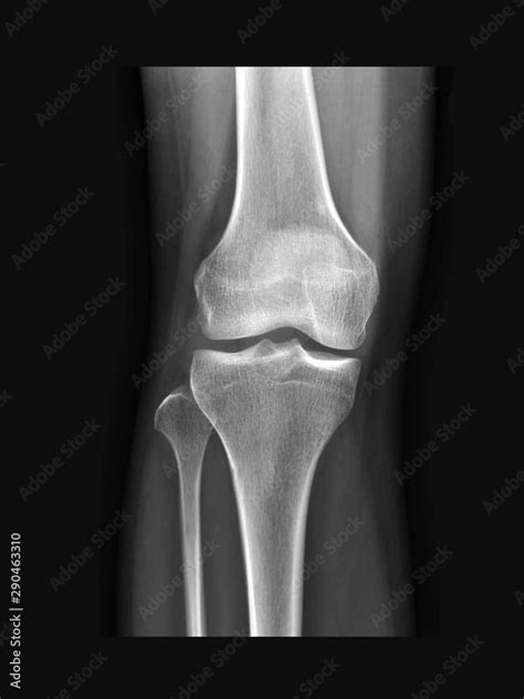 Film knee x-ray radiograph show normal human anatomy of knee, leg, thigh bone and joint (tibia ...