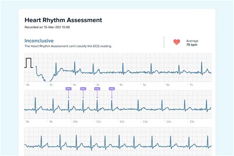 What Ectopic Atrial Rhythm Looks Like on Your Watch ECG | Qaly