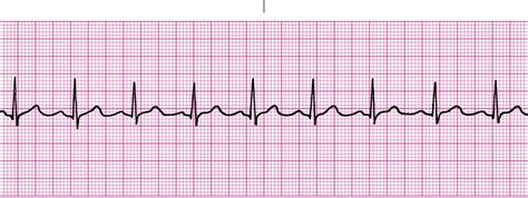 EKG dysrhythmias - StudyBlue