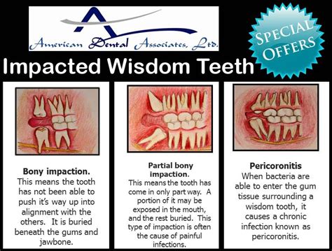 Causing Wisdom teeth problem!! Schedule appointment and get relief from your wisdom teeth pain ...