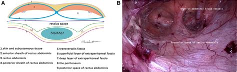 Frontiers | Using the concept of preperitoneal membrane anatomy in total extraperitoneal ...