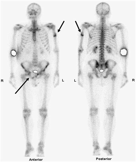 Functioning Metastases from Thyroid Papillary Carcinoma in Bone | Journal of Nuclear Medicine ...