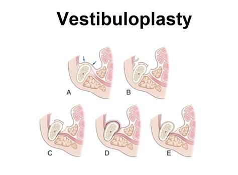 What is Vestibuloplasty? | News | Dentagama