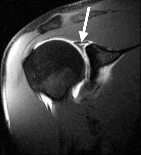 Glenohumeral Ligament Mri