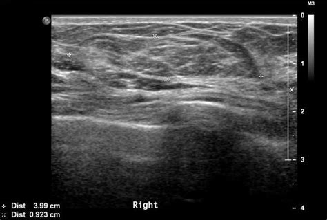 Breast hamartoma | Radiology Reference Article | Radiopaedia.org