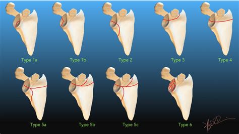 Ideberg Classification of Scapular Fractures | UW Emergency Radiology